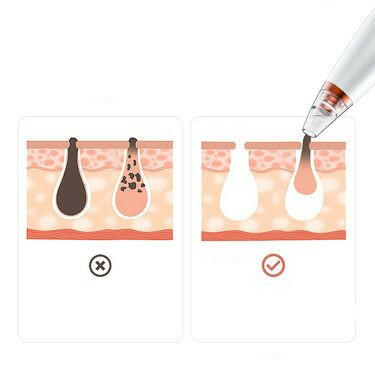 Comparative diagram showing a skincare tool removing blackheads and impurities for cleaner pores, part of MIANIMED premium skincare.